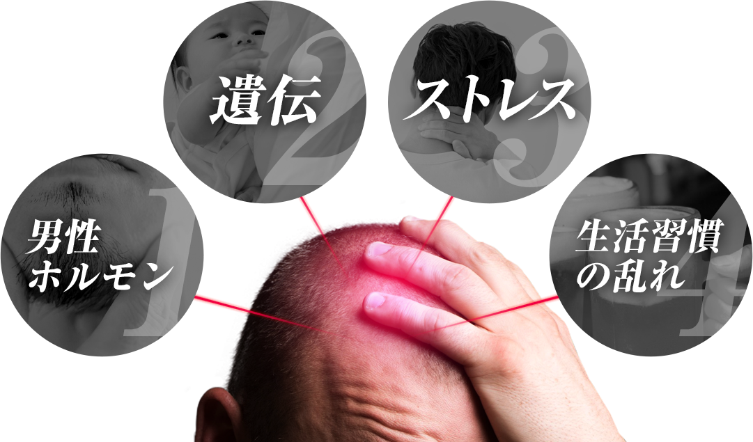 男性ホルモン 遺伝 ストレス 生活習慣の乱れ